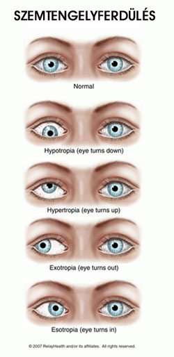 A szemtengelyferdülés típusai; Kép forrása: Pediatric Eye Disease Investigator Group