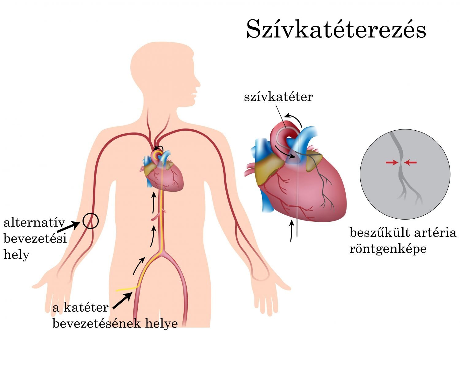 szívkatéterezés