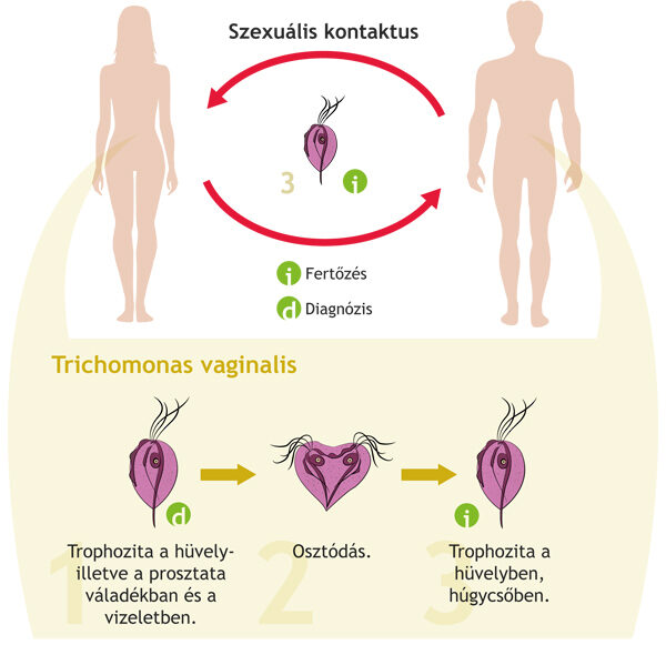 A nőknél a trichomonas okoz kezelést