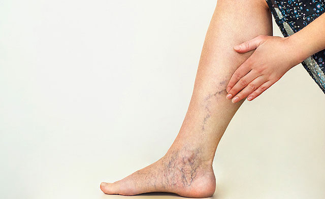 A böjt gyógyítja a visszér visszéreket a lábakon. Főzetek a kismedence visszértágulatához