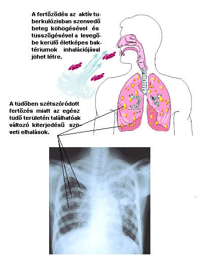 Tüdőtuberkulózis
