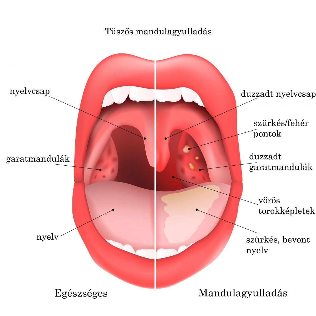 Tonsillitis és prosztata kommunikáció