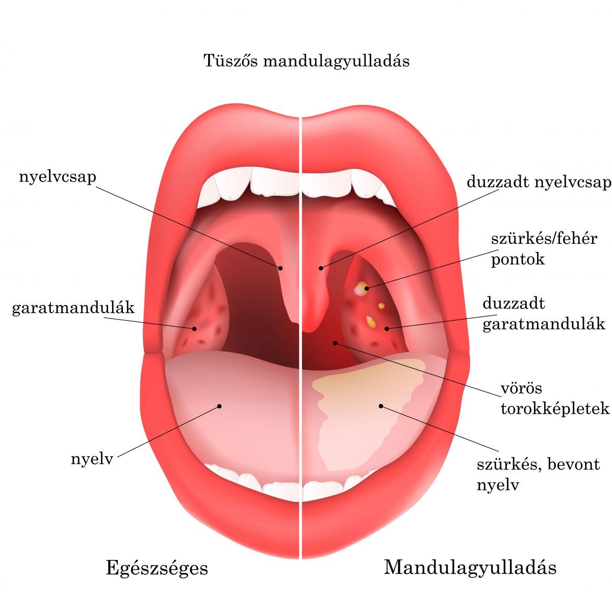 prostatitis és mandulagyulladás)