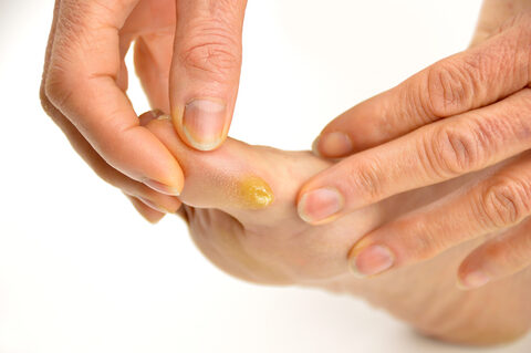 hogyan kezeljük az artrózist a lábujjakon