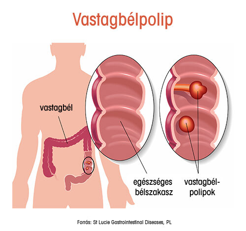 A vastagbélpolip