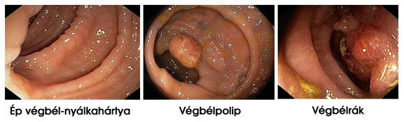 Kolonoszkópia - Ép nyálkahártya, végbélpolip és végbélrák