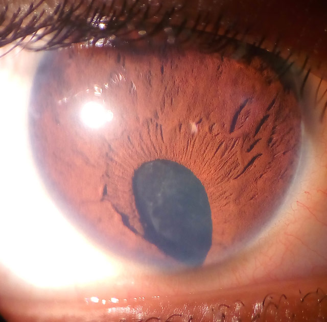 Veleszületett iris coloboma