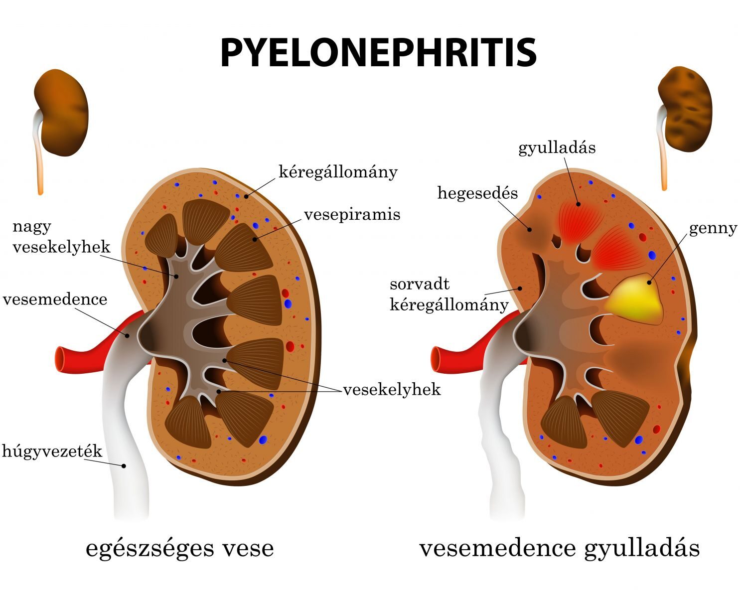 Pyelonephritis a kezelt diabéteszes betegeknél