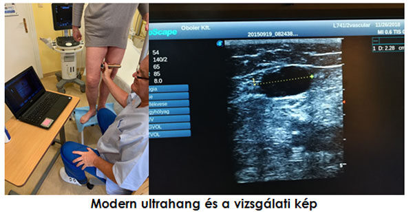 ultranagos visszér vizsgálat