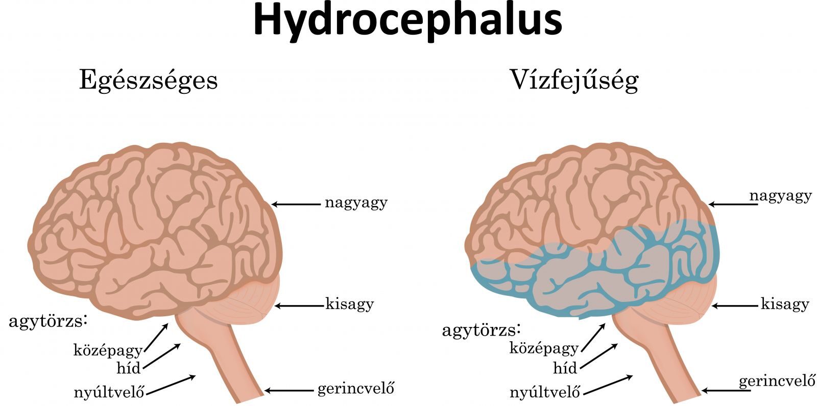 Vízfejűség